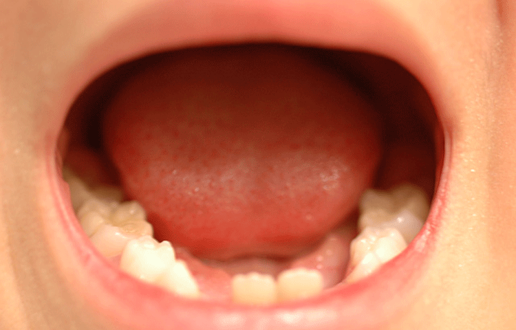 乳歯は永久歯に比べて虫歯になりやすい