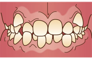 宇治市　歯医者　crowding　なかむら歯科医院