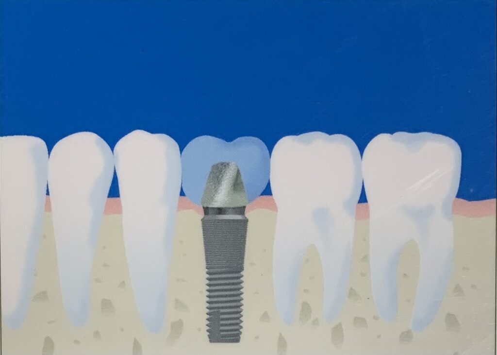 宇治市　歯医者　implant shama　なかむら歯科医院
