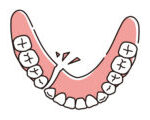 宇治市　歯医者　broken denture1　なかむら歯科医院