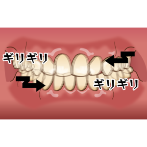 宇治市　歯医者　braxism　なかむら歯科医院