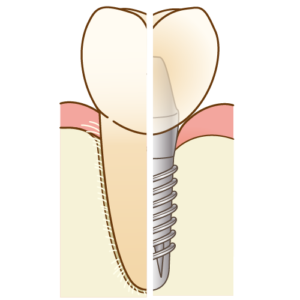 宇治市　歯医者　implant-tooth　なかむら歯科医院