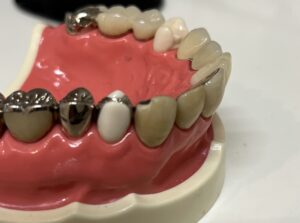 宇治市　歯医者　CR　fracture　なかむら歯科医院