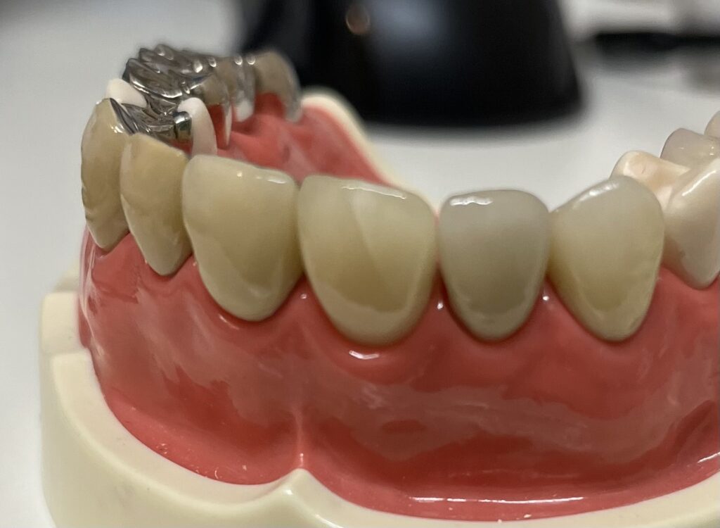 宇治市　歯医者　ceramic fracture　なかむら歯科医院