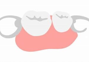 宇治市　歯医者　partial denture　なかむら歯科医院