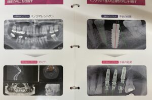 宇治市　歯医者　digital implant　なかむら歯科医院