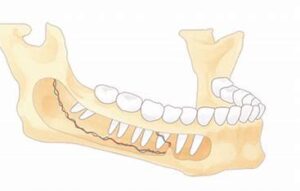 宇治市　歯医者　inferior alveolar nerve　なかむら歯科医院