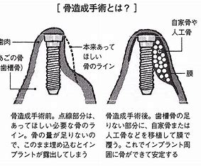 宇治市　歯医者　new bone　なかむら歯科医院