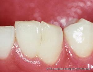 宇治市　歯医者　fused teeth　なかむら歯科医院