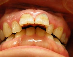 宇治市 歯医者 open bite2 なかむら歯科医院