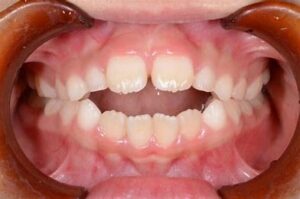 宇治市　歯医者　open bite3　なかむら歯科医院