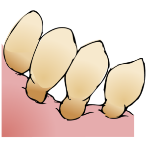宇治市　歯医者　gum recession　なかむら歯科医院