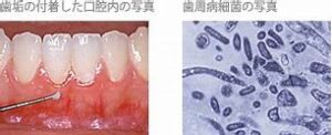 宇治市　歯医者　plaque　なかむら歯科医院