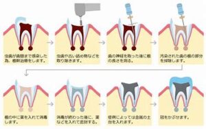 宇治市　歯医者　root canal treatment　なかむら歯科医院