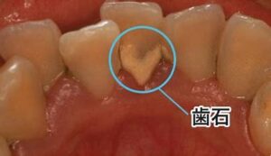 宇治市　歯医者　tartar　なかむら歯科医院