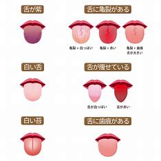 宇治市　歯医者　tongue disease　なかむら歯科医院