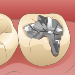 宇治市　歯医者　2nd caries　なかむら歯科医院