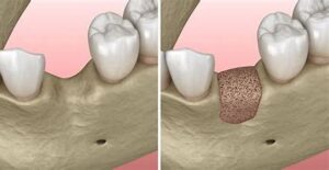 宇治市　歯医者　bone augmentation　なかむら歯科医院