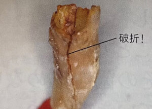 宇治市　歯医者　fracture　なかむら歯科医院