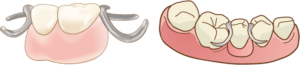 宇治市　歯医者　partial denture　なかむら歯科医院