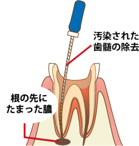 宇治市　歯医者　root　なかむら歯科医院