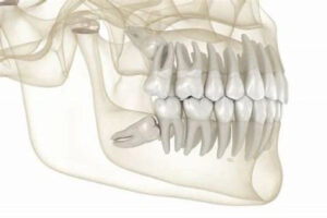 宇治市　歯医者　wisdom tooth　なかむら歯科医院