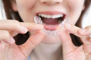 宇治市 歯医者 night guard なかむら歯科医院