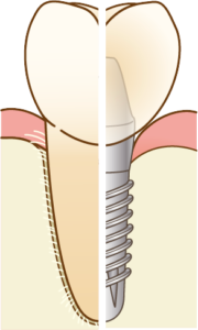 宇治市　歯医者　tooth implant　なかむら歯科医院