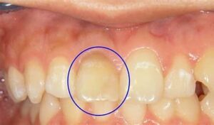 宇治市　歯医者　devitalized teeth　なかむら歯科医院