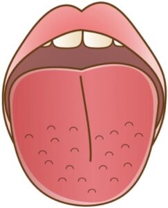 宇治市　歯医者　red tongue 　なかむら歯科医院