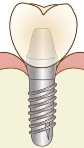 宇治市　歯医者　implant　なかむら歯科医院