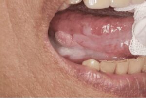 宇治市　歯医者　leukoplakia　なかむら歯科医院