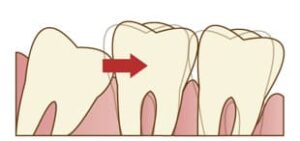 宇治市 歯医者 third molar なかむら歯科医院