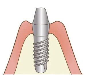 宇治市　歯医者　implant　なかむら歯科医院