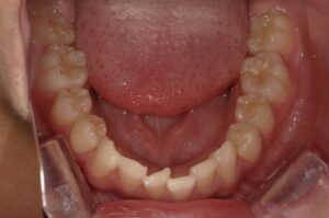 宇治市　歯医者　6462_ry_Oral lower_20231002　なかむら歯科医院