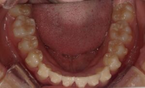 宇治市　歯医者　6462_ry_Oral lower_20240522　なかむら歯科医院