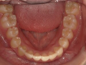 宇治市　歯医者　6462_ry_Oral lower_20241120　なかむら歯科医院