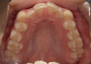 宇治市　歯医者　6462_ry_Oral upper_20231002　なかむら歯科医院
