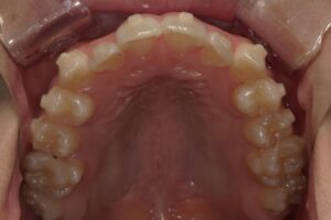 宇治市　歯医者　6462_ry_Oral upper_20240214　なかむら歯科医院