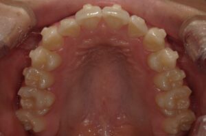 宇治市　歯医者　6462_ry_Oral upper_20240522　なかむら歯科医院
