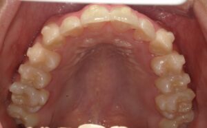 宇治市　歯医者　6462_ry_Oral upper_20240819　なかむら歯科医院