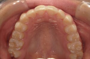 宇治市　歯医者　6462_ry_Oral upper_20241120　なかむら歯科医院