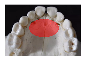 宇治市　歯医者　incisor suture　なかむら歯科医院
