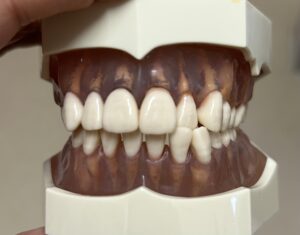 宇治市　歯医者　1tooth class 3　なかむら歯科医院