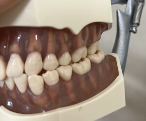 宇治市　歯医者　cross bite　なかむら歯科医院