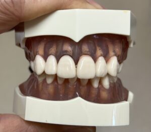 宇治市　歯医者　deep bite　なかむら歯科医院