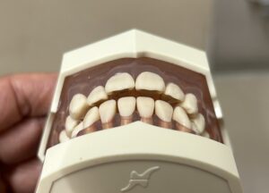 宇治市　歯医者　open bite　なかむら歯科医院