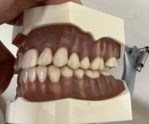 宇治市　歯医者　scissors bite　なかむら歯科医院