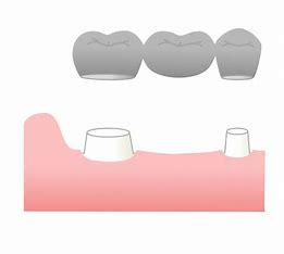 宇治市　歯医者　bridge　なかむら歯科医院