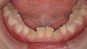 宇治市　歯医者　6843_mn_Oral lower_20240321　なかむら歯科医院